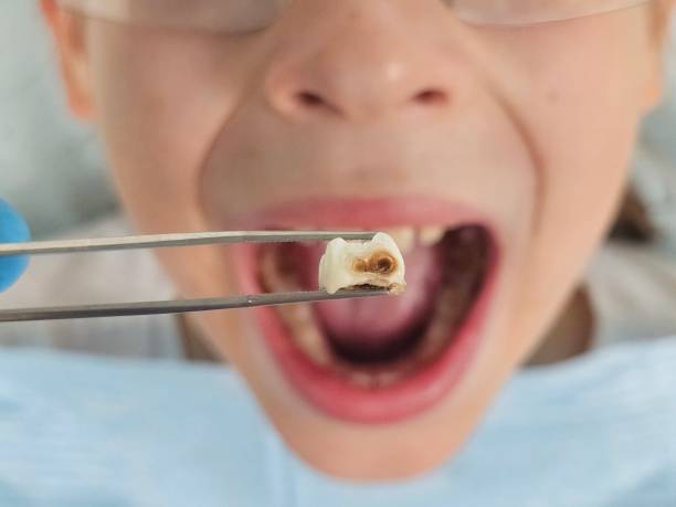 Best Emergency Dental Care for Abscessed Tooth in Swannanoa, NC